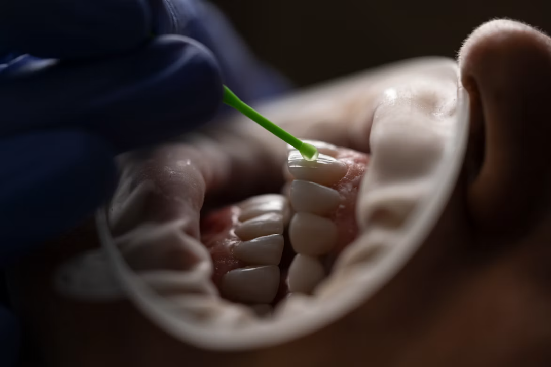 Dental cleaning treatment at Tooth Zone
